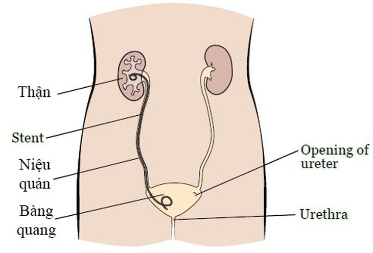 Nữ bệnh nhân quên tái khám rút stent nhựa trong thận và bàng quang - Ảnh 2.