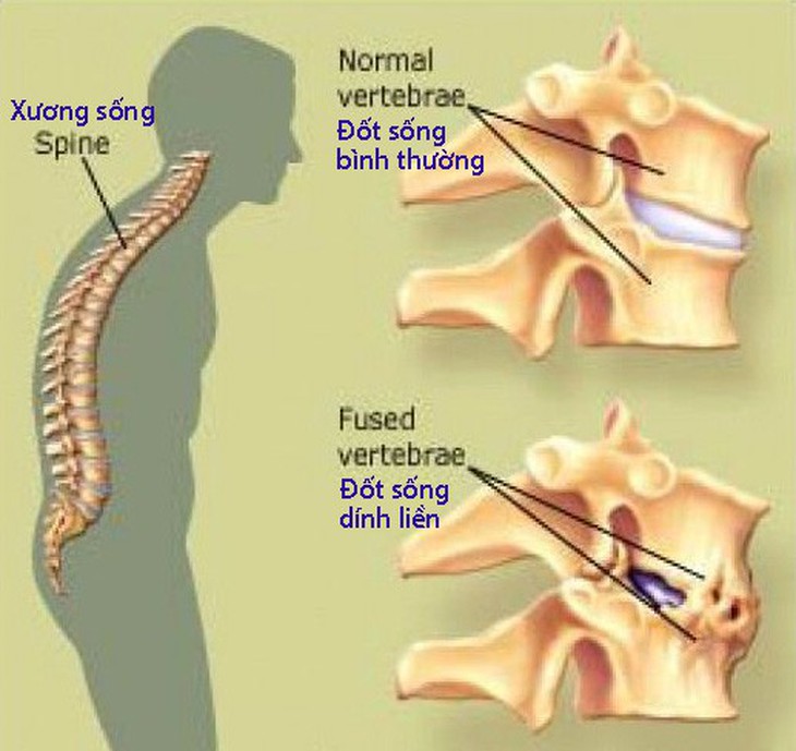 Cần biết về bệnh viêm cột sống dính khớp - Ảnh 1.