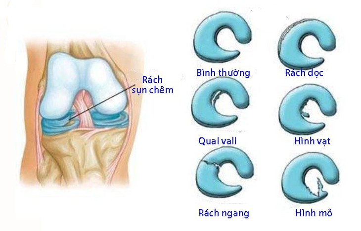 Rách sụn chêm - Ảnh 1.