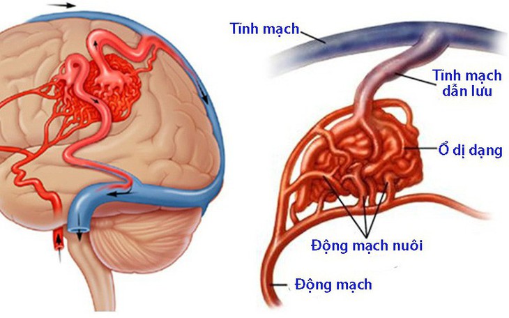 Dị dạng mạch máu dạng hang