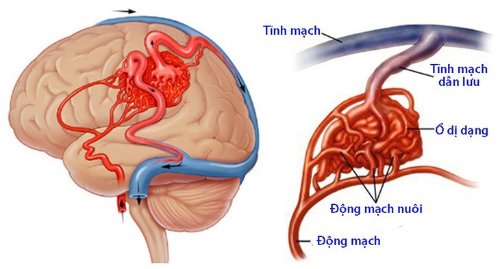 Dị dạng mạch máu dạng hang - Ảnh 1.