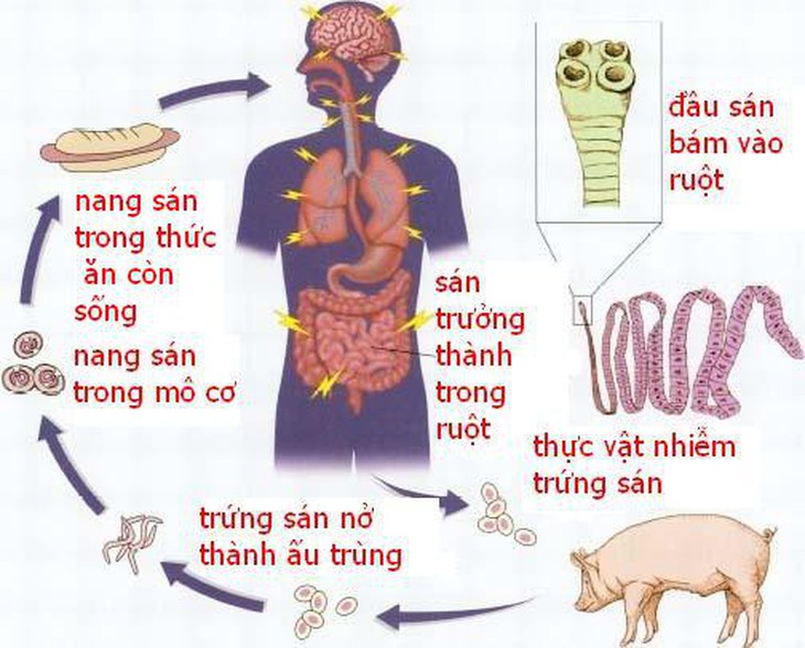 Hành trình sán chu du và kẹt... ở não - Ảnh 1.