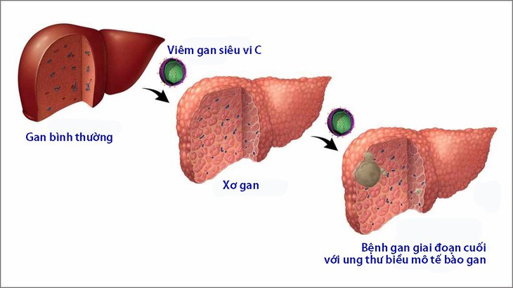 Thắc mắc thường gặp về viêm gan siêu vi C - Ảnh 1.