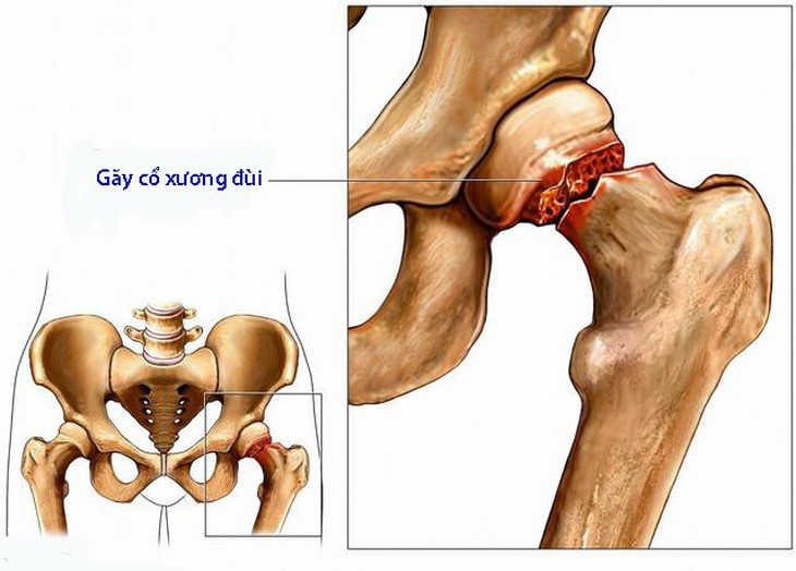 Gãy khớp hông - Ảnh 1.