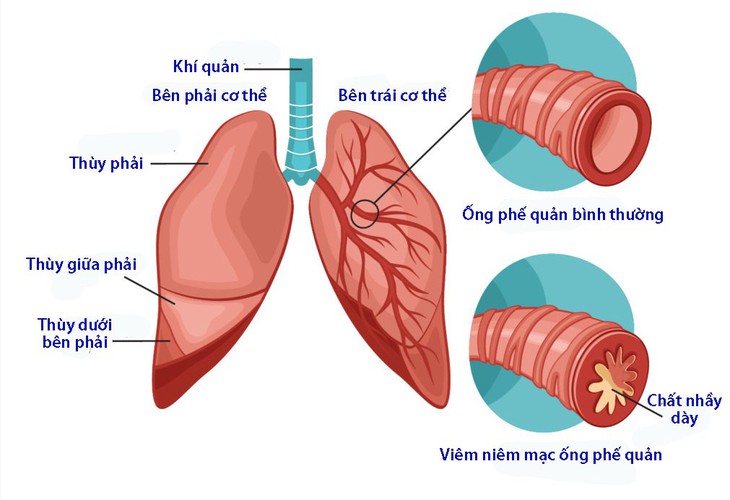 Phân biệt viêm phế quản do virus và viêm phế quản do vi khuẩn - Ảnh 1.