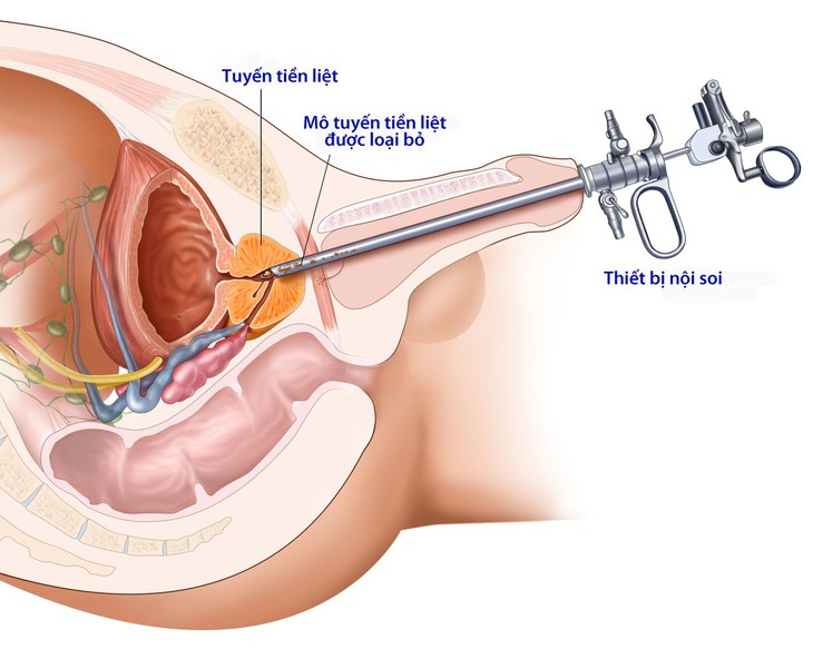 Đàn ông khó tiểu - Ảnh 1.