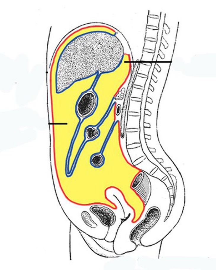 Viêm phúc mạc: Nguyên nhân, điều trị và phòng ngừa - Ảnh 1.