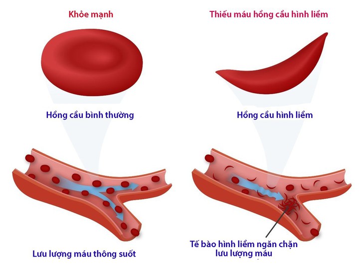 Bệnh thiếu máu hồng cầu hình liềm ở trẻ nhỏ - Ảnh 1.