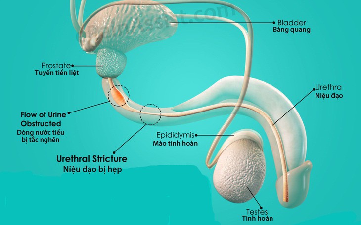 Hẹp niệu đạo