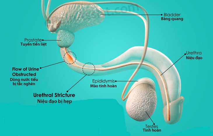 Hẹp niệu đạo - Ảnh 1.