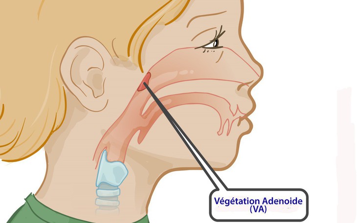 Viêm VA ở trẻ em