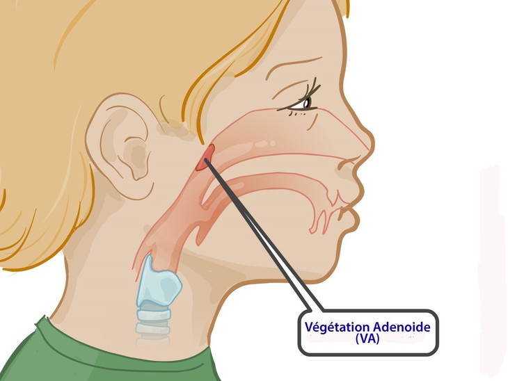 Viêm VA ở trẻ em - Ảnh 1.