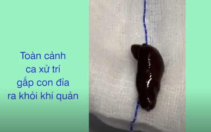 Rùng mình với clip con đỉa trong khí quản bệnh nhân ở Bệnh viện T.Ư Quân đội 108