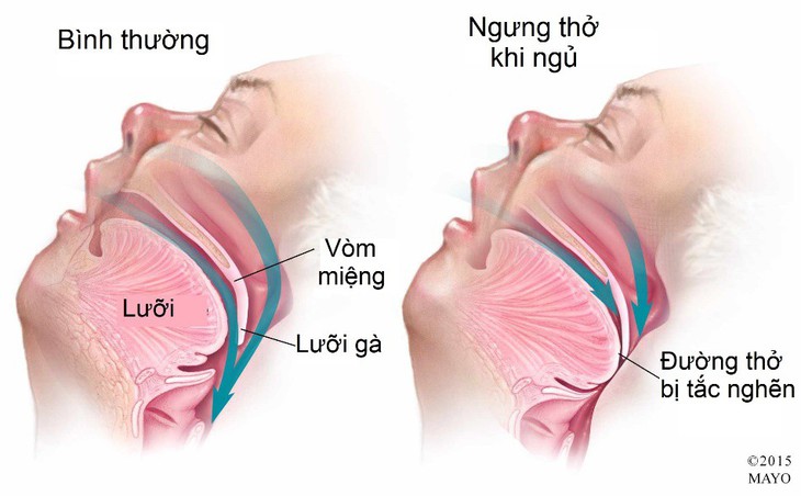 Ngáy to vô lo hay đáng lo? - Ảnh 1. Ngáy to vô lo hay đáng lo? - Ảnh 1.