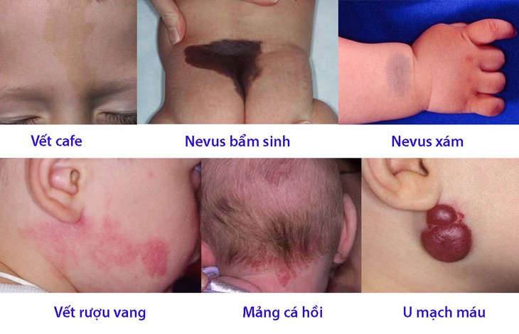 Điểm mặt các loại bớt ở trẻ em - Ảnh 1. Điểm mặt các loại bớt ở trẻ em - Ảnh 1.