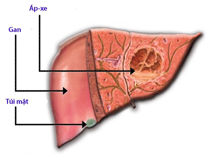 Áp-xe gan nguyên nhân và phương pháp điều trị - Ảnh 1.