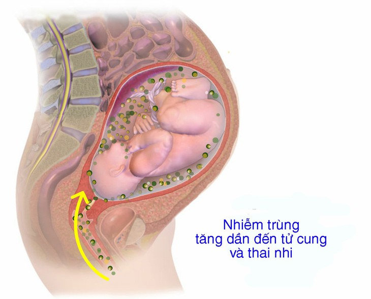 Viêm màng ối và thai kỳ - Ảnh 1. Viêm màng ối và thai kỳ - Ảnh 1.