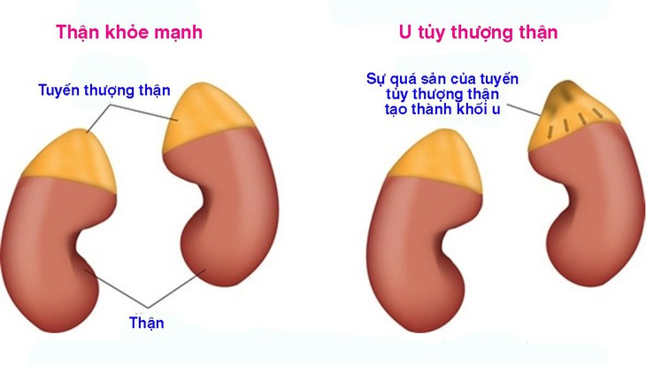 U tủy thượng thận - Ảnh 1.