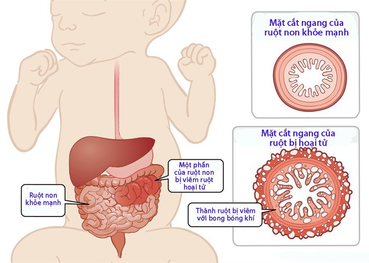 Viêm ruột hoại tử ở trẻ sơ sinh - Ảnh 1.