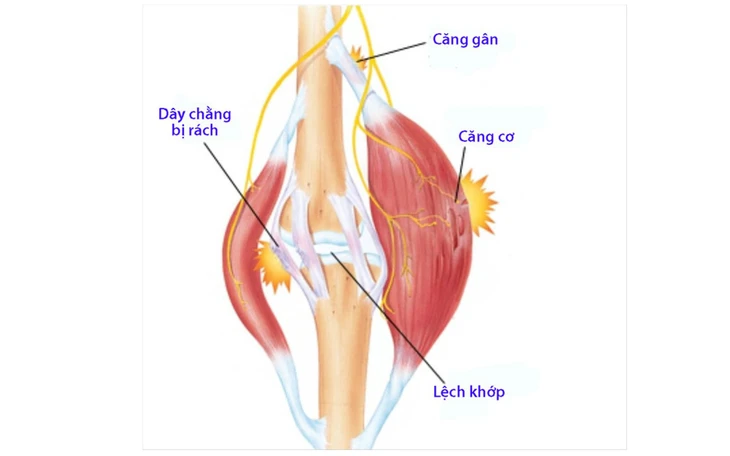 Quả cầu lông đập trúng mắt gây dập nhãn cầu, nguy cơ mất thị lực - Ảnh 2.