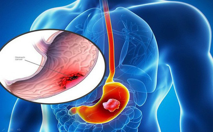 Có thể điều trị ung thư dạ dày không phẫu thuật không? - Ảnh 1.