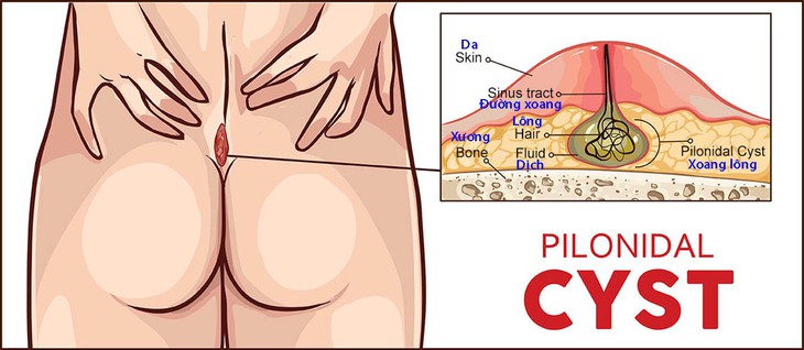 Bệnh nang lông dưới da vùng xương cùng cụt - xoang lông - Ảnh 1.