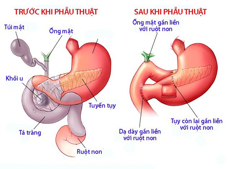 Những điều cần biết về Glucagonoma - Ảnh 1.