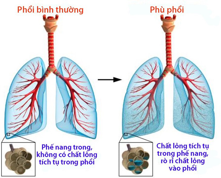 Phù phổi - Ảnh 1.