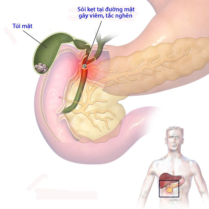Nhiễm trùng đường mật - Ảnh 1.