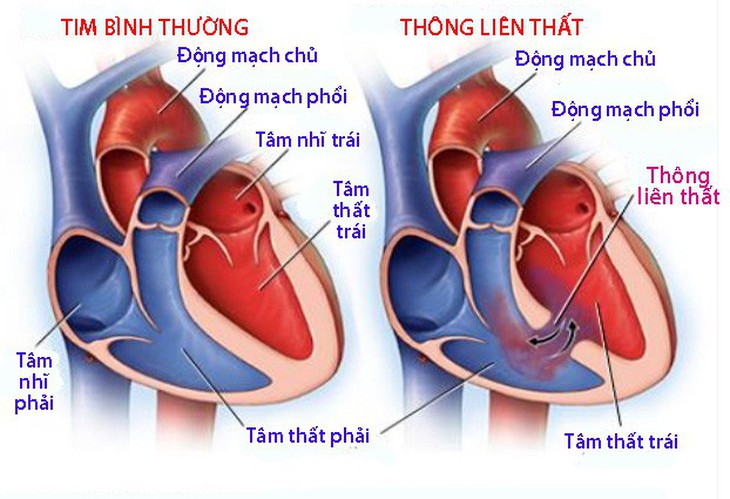 Dị tật thông liên thất - Ảnh 1.