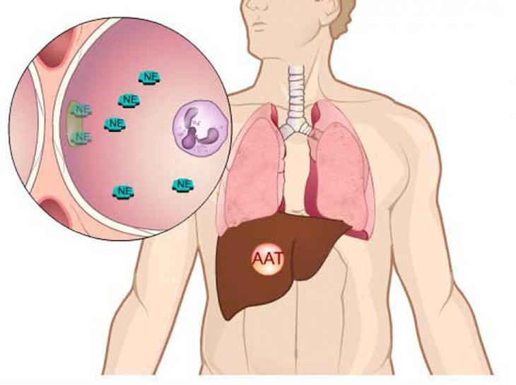 Bệnh thiếu hụt men Alpha-1-Antitripsin - Ảnh 1.