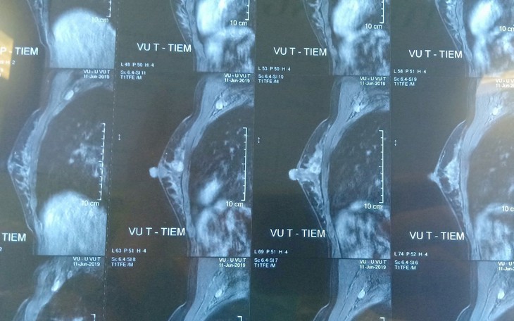 29 tuổi đã bị ung thư vú, cảnh báo phụ nữ Việt mắc bệnh ung thư vú sớm