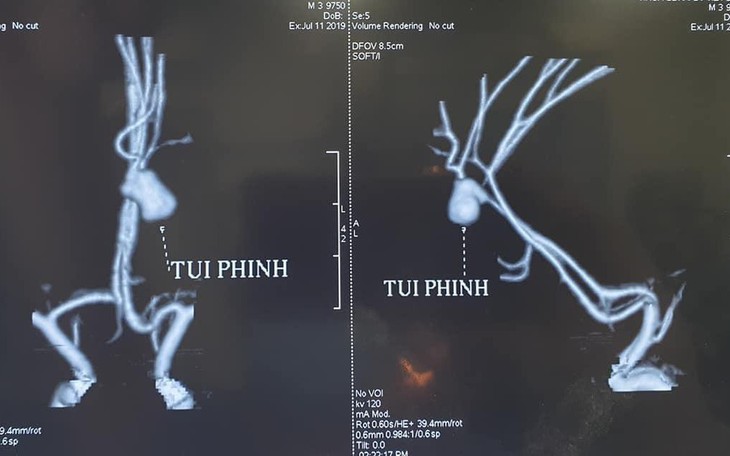 Bác sĩ kinh ngạc khi gặp ca phình mạch não vỡ ở trẻ 3 tuổi