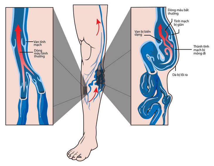 Nguyên nhân của suy giãn tĩnh mạch chân và cách chữa - Ảnh 1.