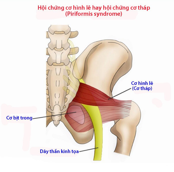 Hội chứng cơ hình lê - Ảnh 1.