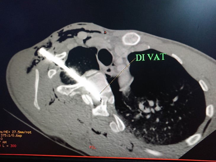 Cứu sống nam thanh niên bị cây sắt đâm xuyên phổi - Ảnh 1.