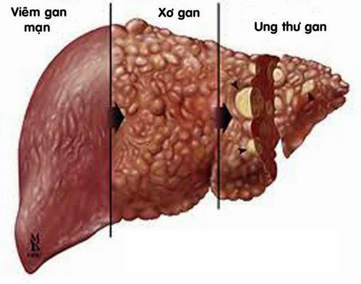 Hợp chất Fucoidan: Liệu pháp phòng ngừa ung thư mới - Ảnh 1.