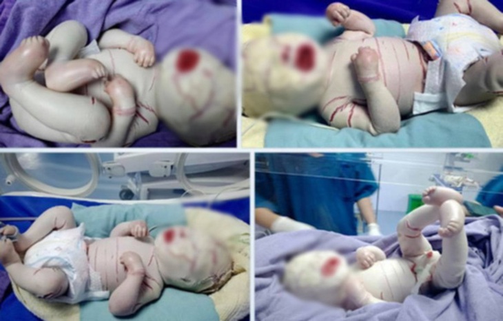 Bé bị vảy cá bẩm sinh tình trạng rất nặng: da căng, ngón tay chân dính nhau - Ảnh 1. Bé bị vảy cá bẩm sinh tình trạng rất nặng: da căng, ngón tay chân dính nhau - Ảnh 1.
