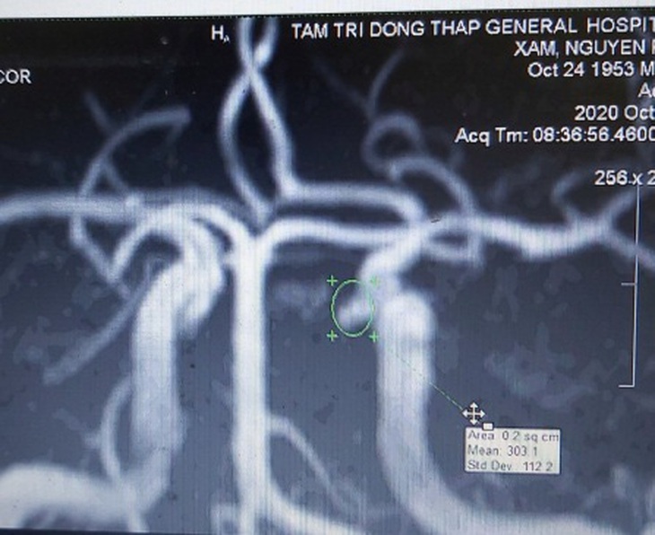 Túi phình động mạch trong não, triệu chứng mơ hồ hậu quả hiện hữu rất lớn - Ảnh 2.