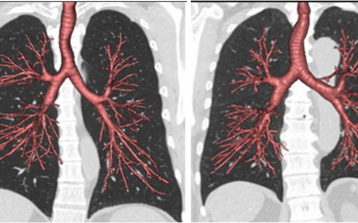 COPD diễn biến âm thầm, làm sao để phát hiện sớm? - Ảnh 2.