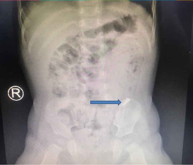 Mảnh kiếng vỡ chạy lung tung trong bụng bé trai 10 tháng tuổi - Ảnh 1.
