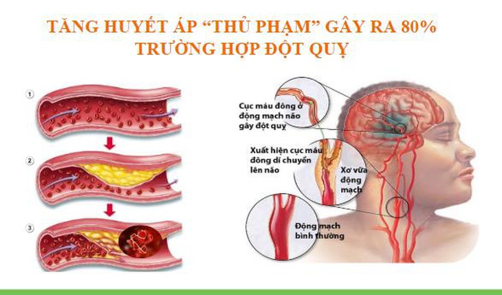 Xu hướng mới trong điều trị tăng huyết áp và phòng ngừa đột quỵ - Ảnh 2.