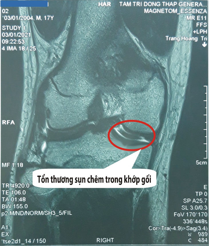 Chụp cộng hưởng từ (MRI) khớp gối: Giải pháp phát hiện tổn thương nhanh, chính xác - Ảnh 2.