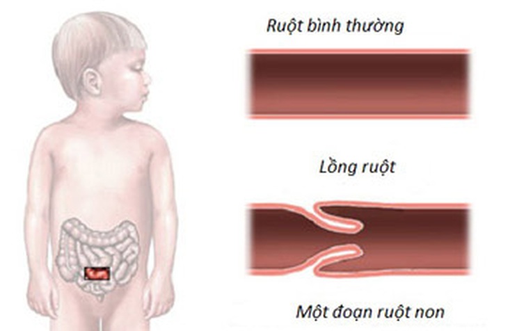 Điều trị lồng ruột ở trẻ em bằng kỹ thuật bơm hơi tại BVĐK Tâm Trí - Ảnh 1.