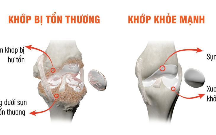 Sống tự chủ hơn nhờ chăm sóc xương khớp đúng cách