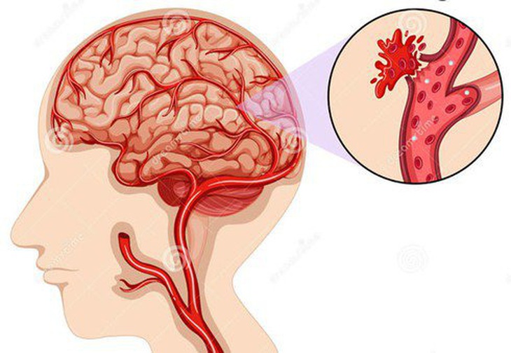 Nâng cao ý thức phòng ngừa đột quỵ trong bối cảnh COVID-19 - Ảnh 1.