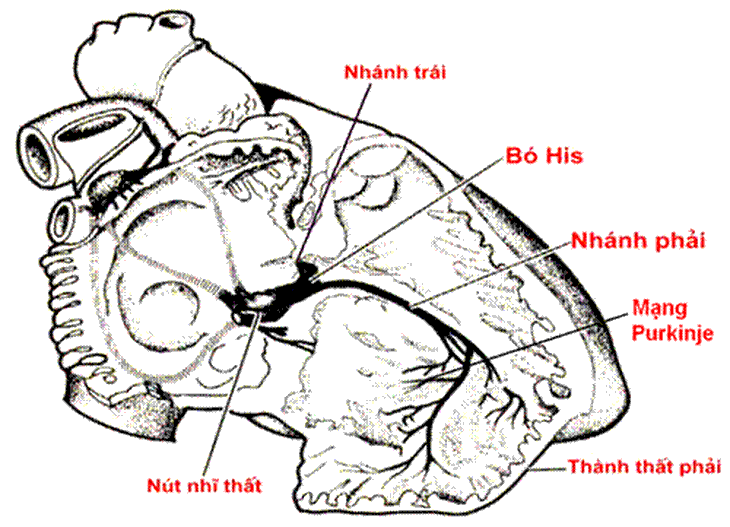 Tin vui cho người suy tim: Ca đầu tiên thực hiện thành công kỹ thuật tạo nhịp tim từ bó his trái - Ảnh 2.