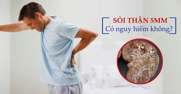 Sỏi 5 - 8 mm có nguy hiểm hay không? - Ảnh 1.