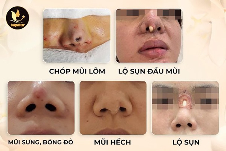Bác sĩ Nguyễn Hữu Hoạt - chuyên gia phục hồi mũi hỏng nổi tiếng tại TP.HCM - Ảnh 2. Bác sĩ Nguyễn Hữu Hoạt - chuyên gia phục hồi mũi hỏng nổi tiếng tại TP.HCM - Ảnh 2.