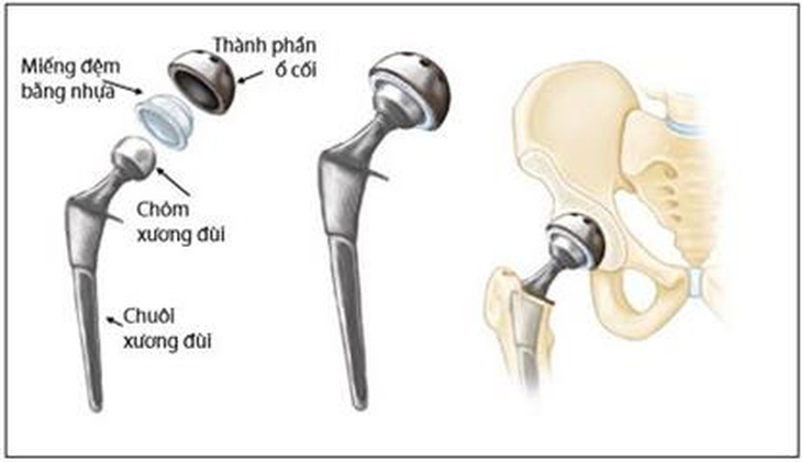 Khớp háng nhân tạo - cứu cánh giúp bệnh nhân gãy cổ xương đùi tránh tàn phế - Ảnh 2.